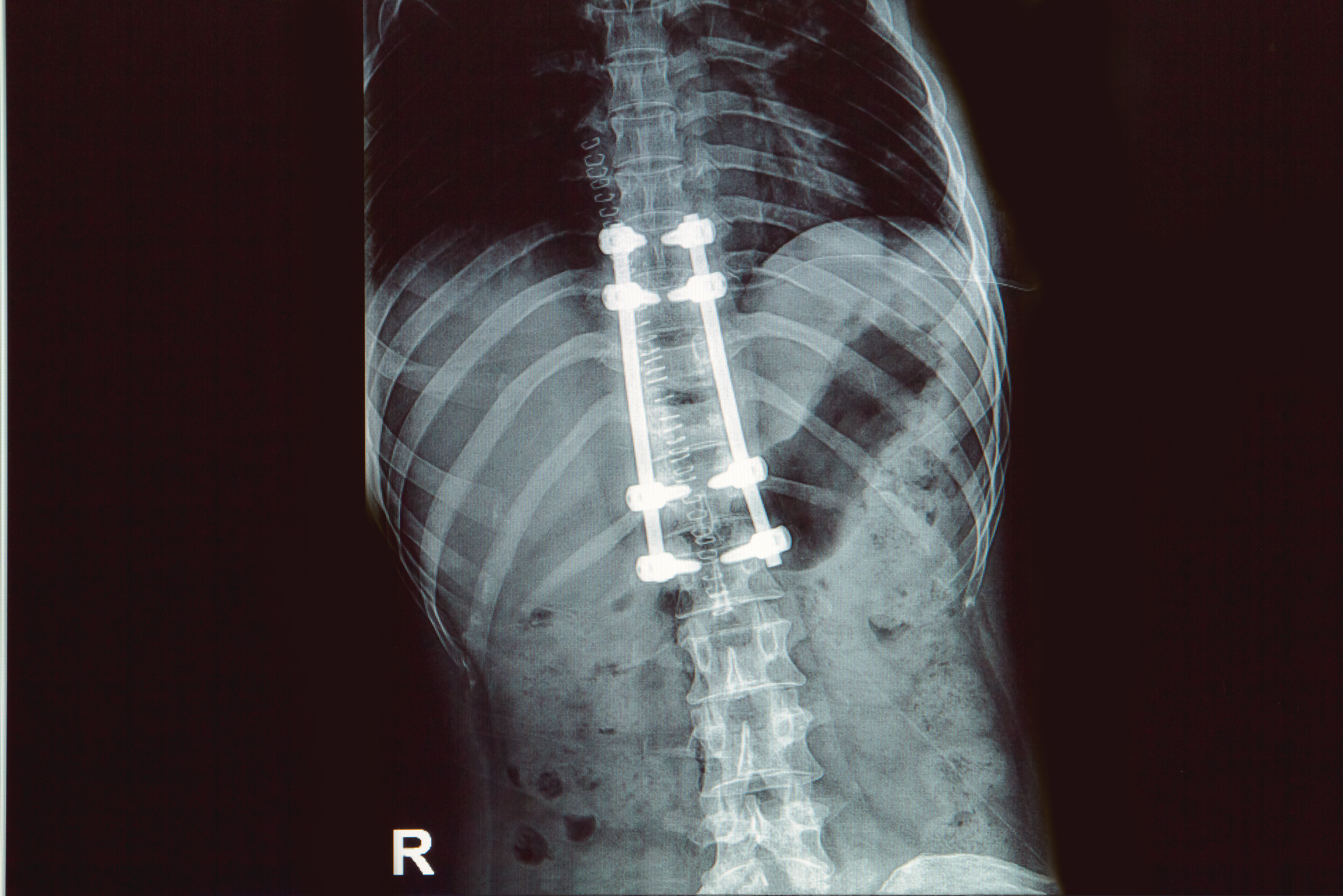 Spinal Fusion Instrumentation Removal: Pros and Cons