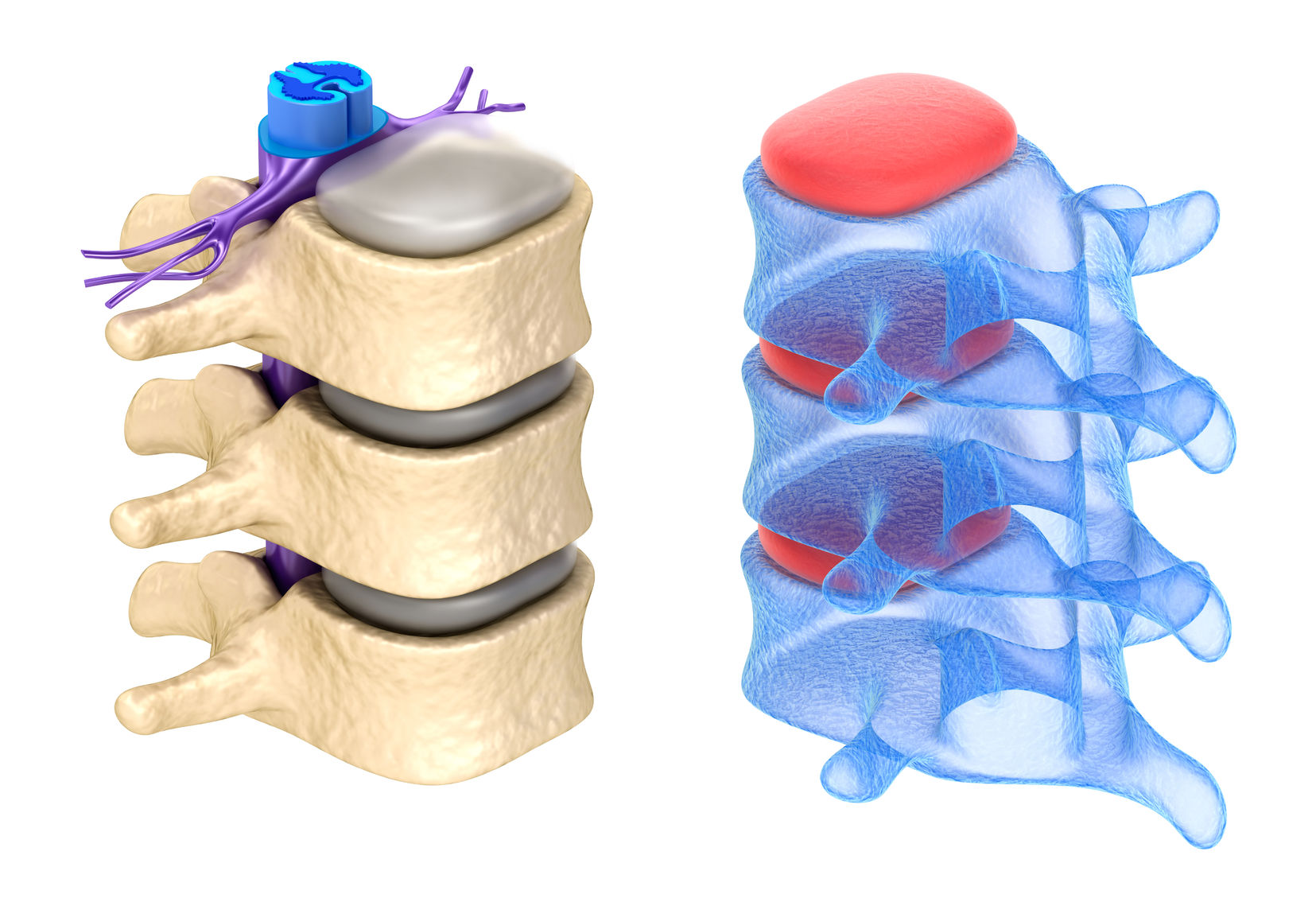 Болит кость позвоночника. Остеохондроз позвоночника 3 д модель. Spine игра. Ламинэктомия позвоночника. Как восстановить хрящевую ткань в позвоночнике.