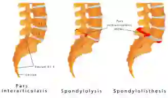 Illustration of Spondylolisthesis spine