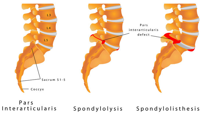 Retrolisthesis Opposite of Spondylolisthesis