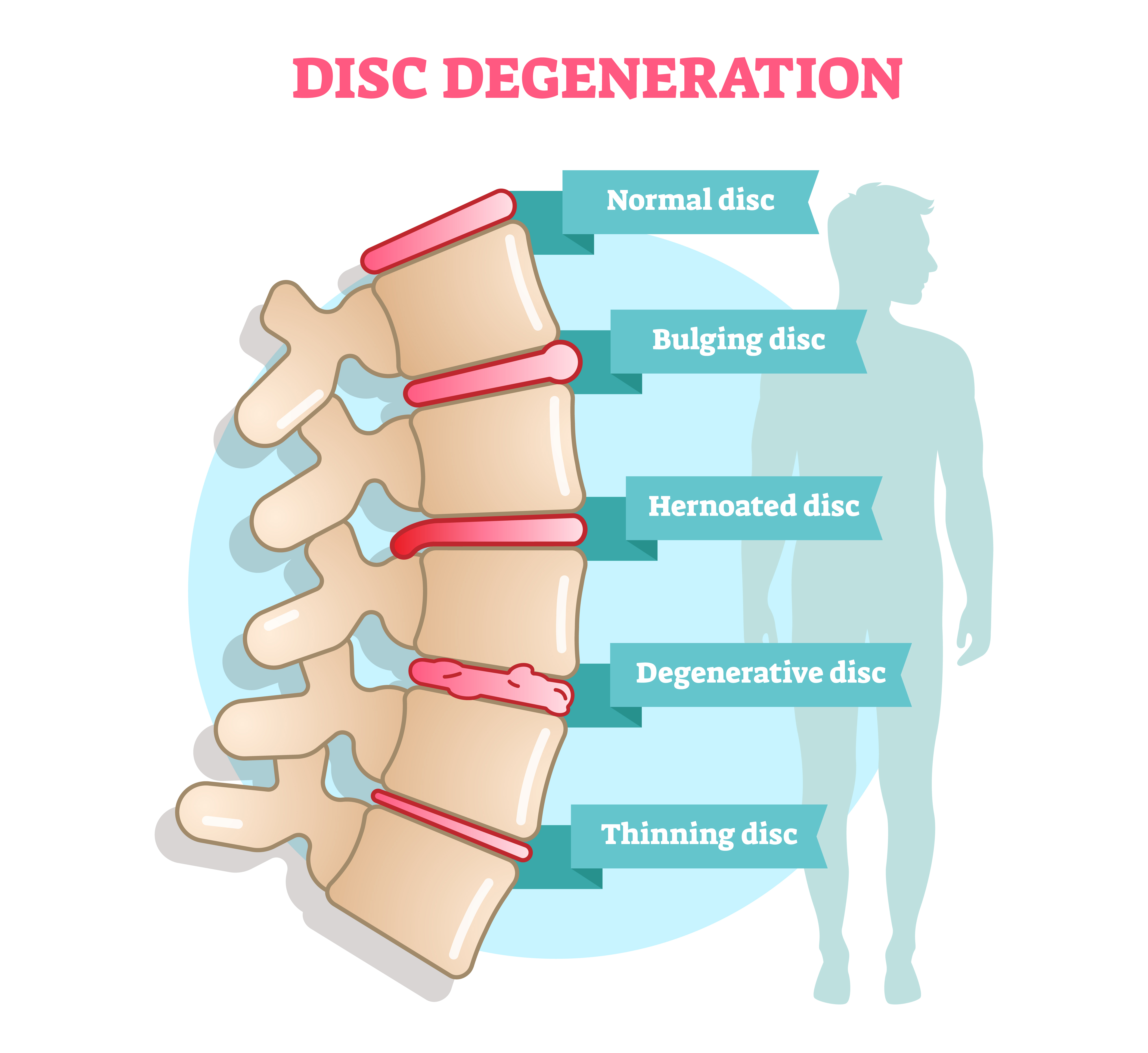 What Causes Degenerative Disc Disease? - BenchMark Physical Therapy