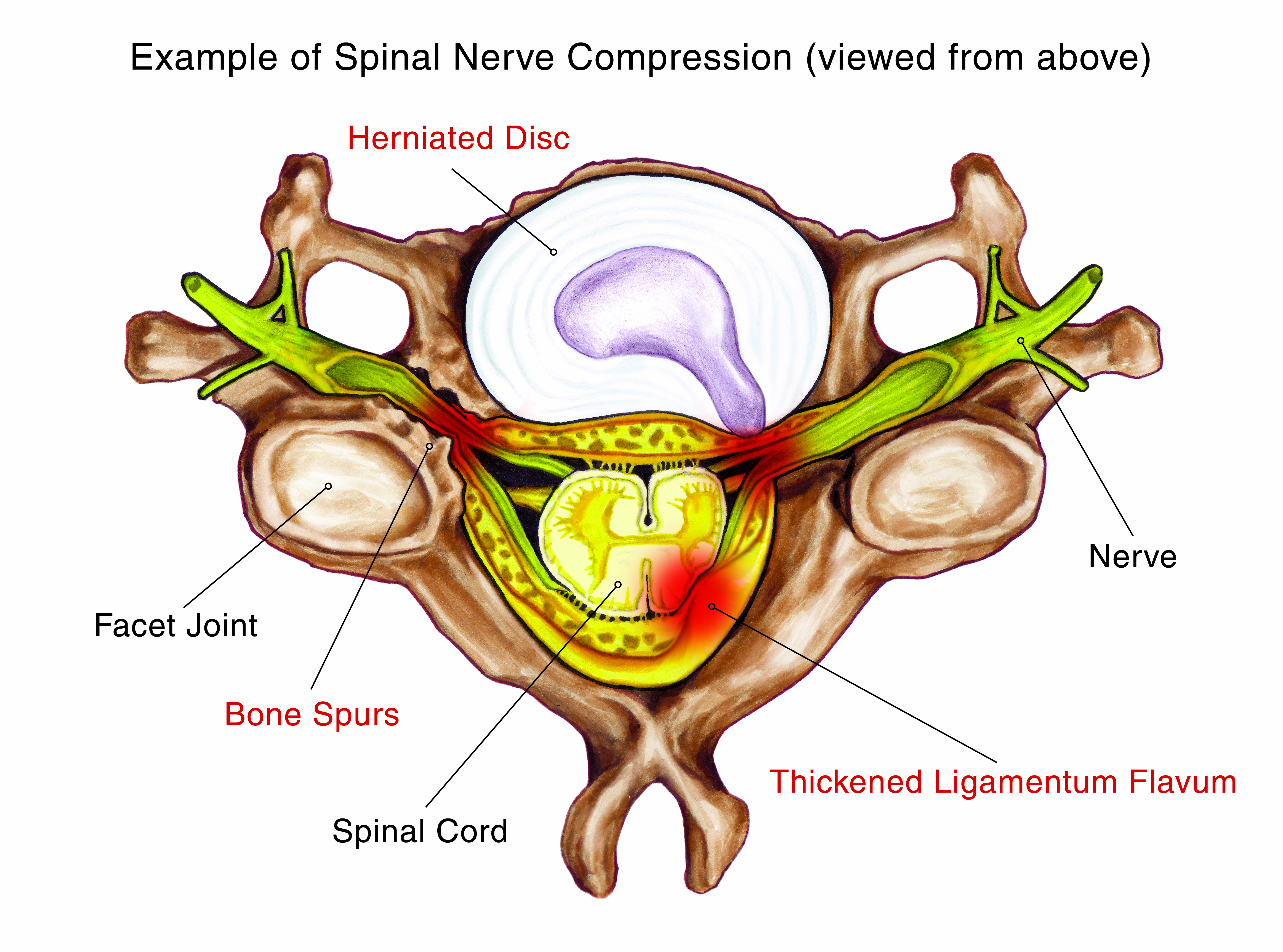 Lumbar Spinal Stenosis - Symptoms & Causes