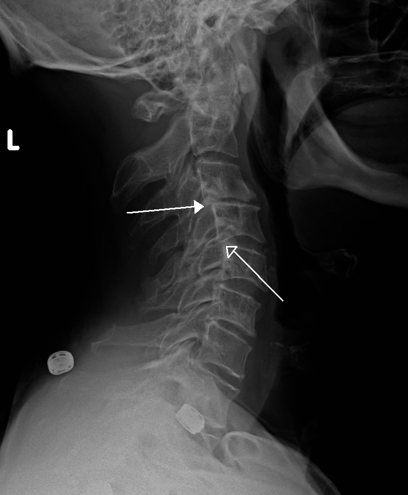 Spinal cord compression - Wikipedia