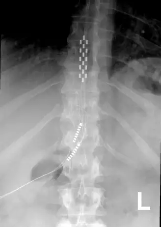 Spinal Cord Stimulator Implant And How It Can Help You - OAS