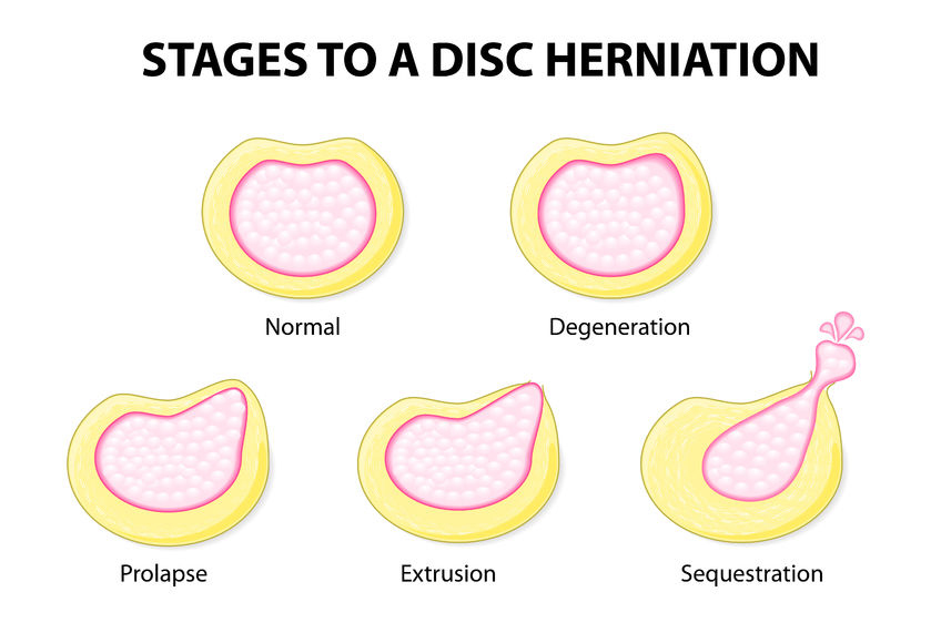 Bulging & Herniated Discs - King Chiropractic