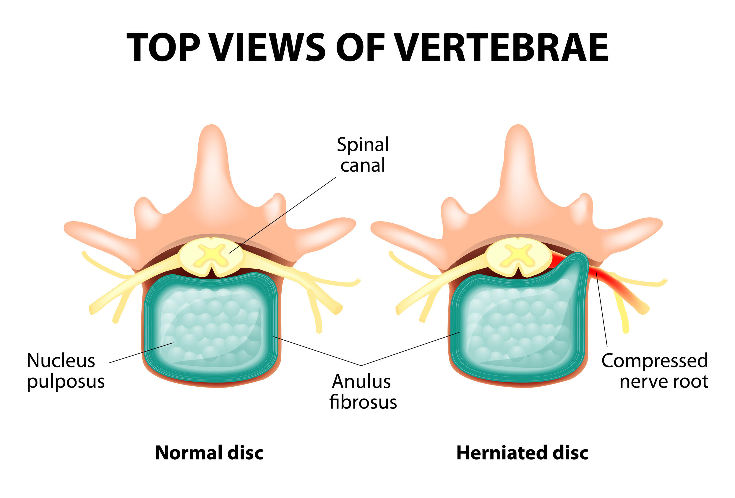 How a Chiropractor Can Help Your Herniated Disc - North Atlanta