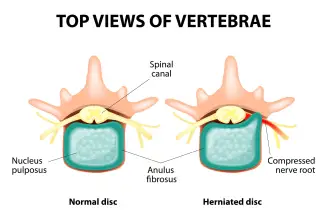 Chiropractic Treatment for a Herniated Disc