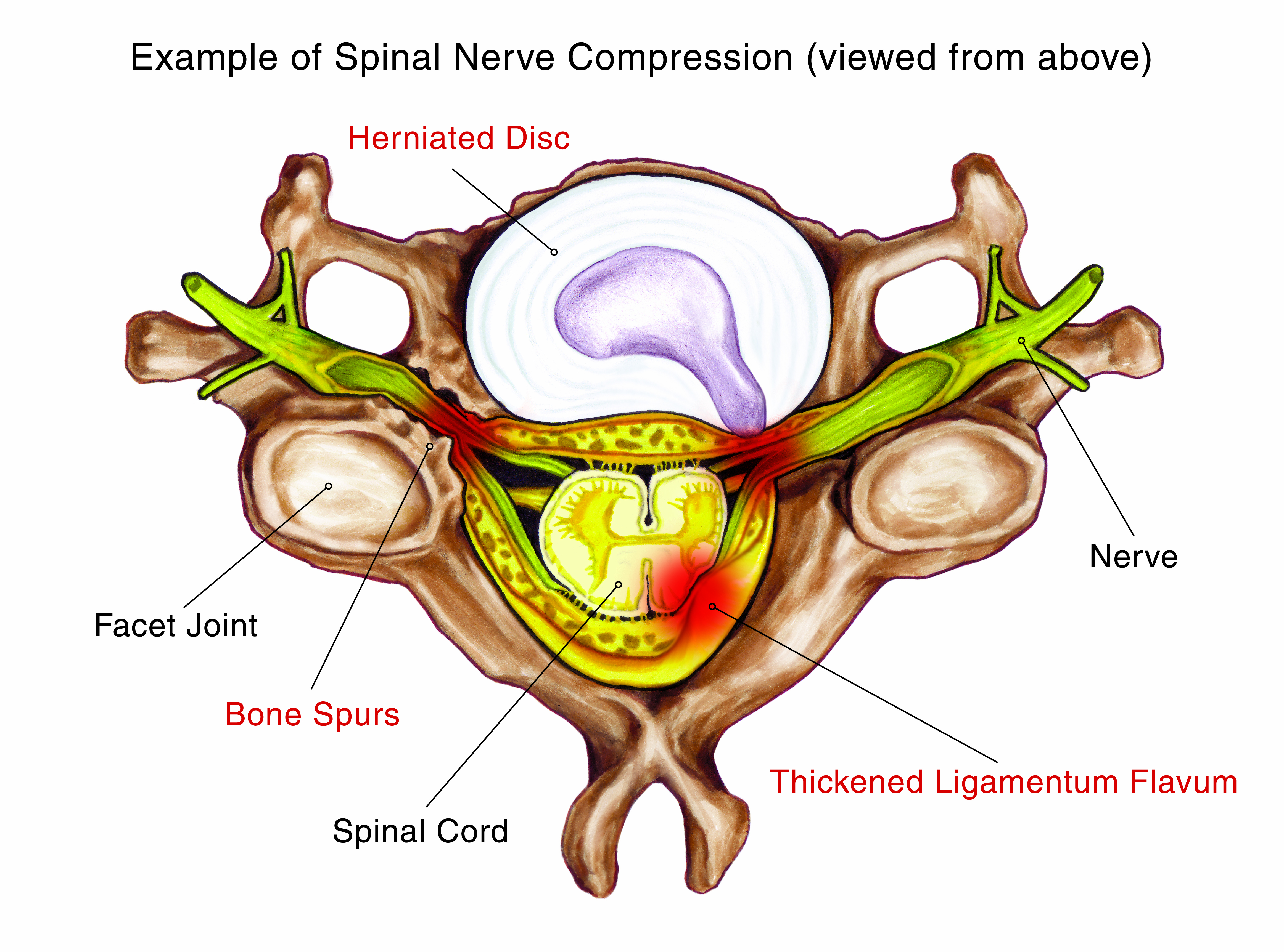 The Importance of Seeing a Physical Therapist for Herniated Disc