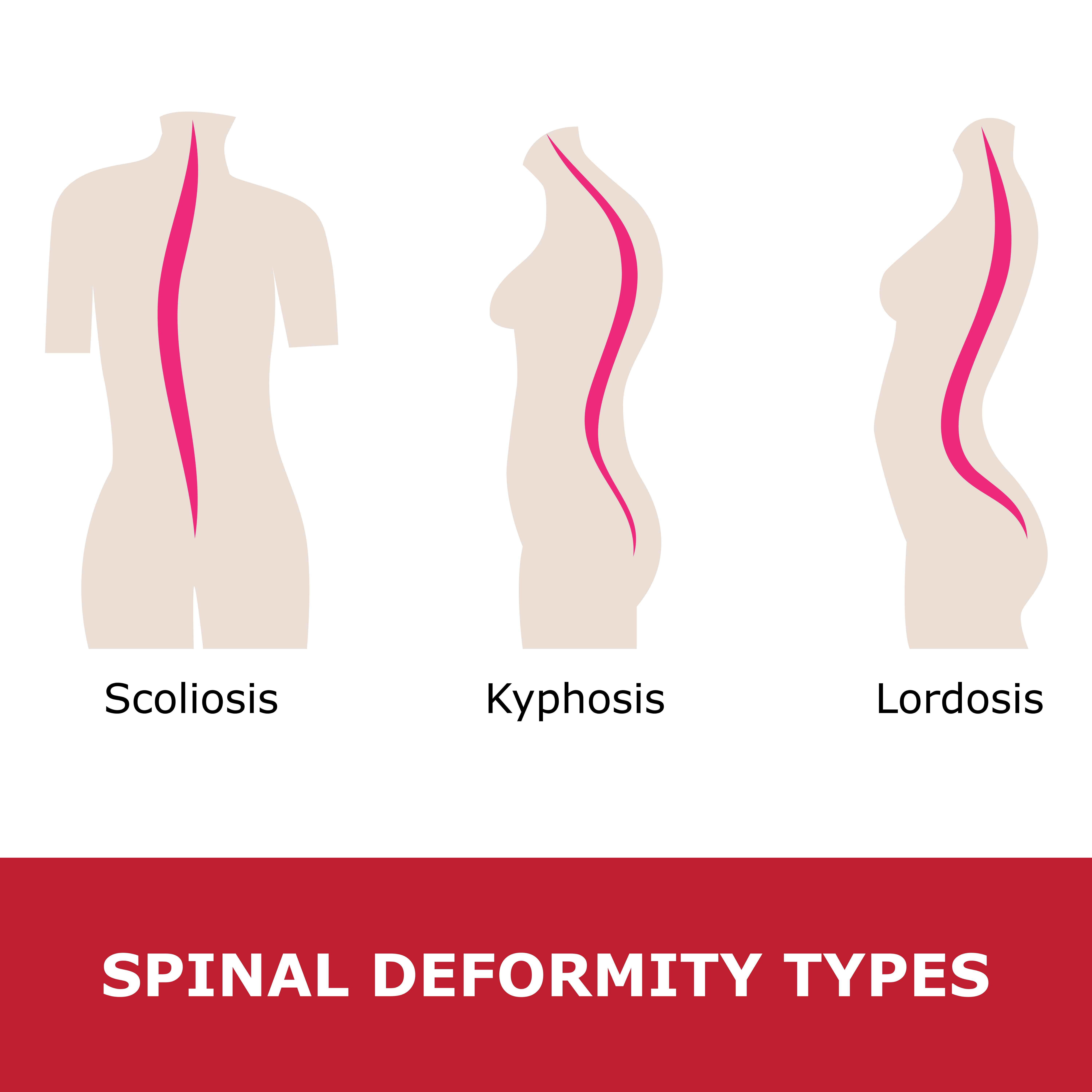 loss of lumbar lordosis due to muscle spasm
