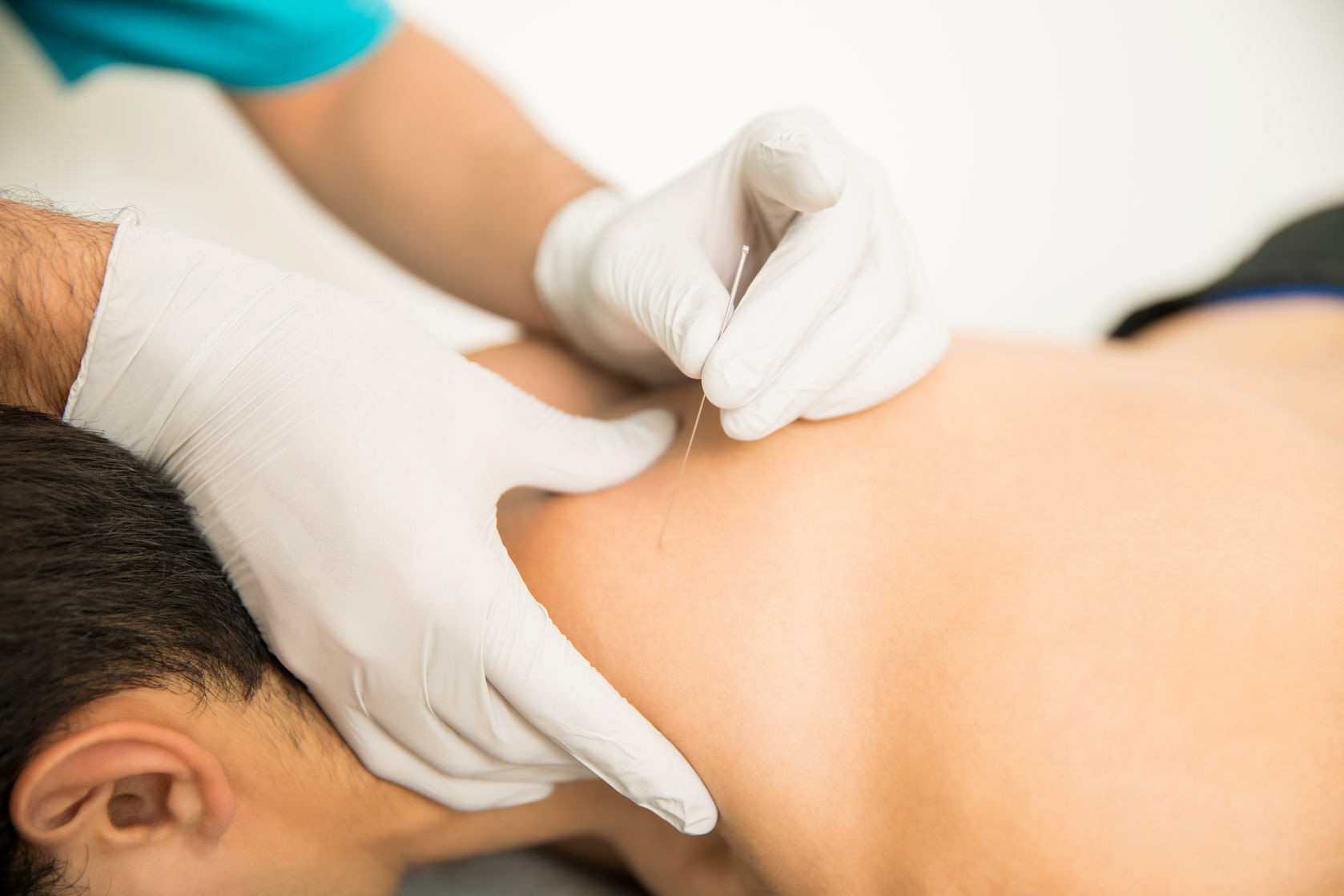 What is Electro-Dry Needling and how can it help with chronic pain and  injury treatment?