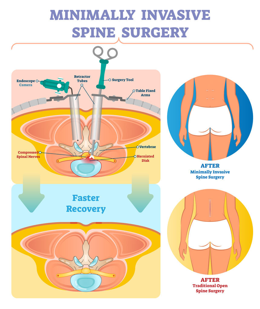 open spine surgery