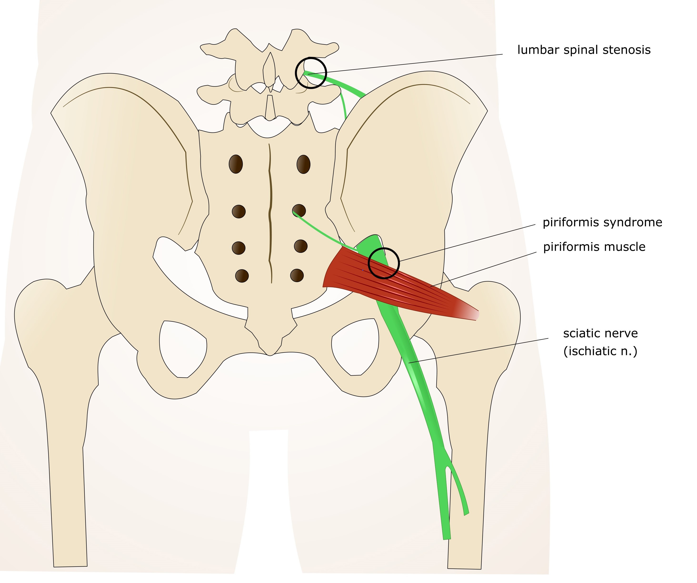 Recovering from Piriformis Syndrome, Deep Gluteal Syndrome or Hip Related  Sciatica - Hip Pain Help