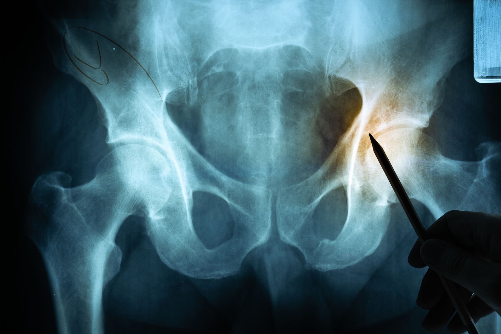 10 Hip Pain Remedies - Center for Spine and Ortho