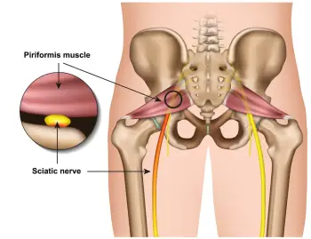 Sciatica and Piriformis syndrome, Kingsley Physio