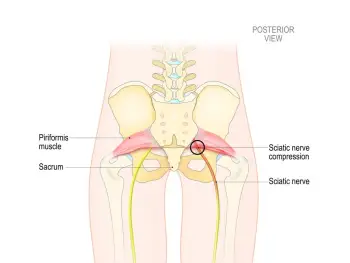 Hip Pain and Sciatica - Complete Orthopedics
