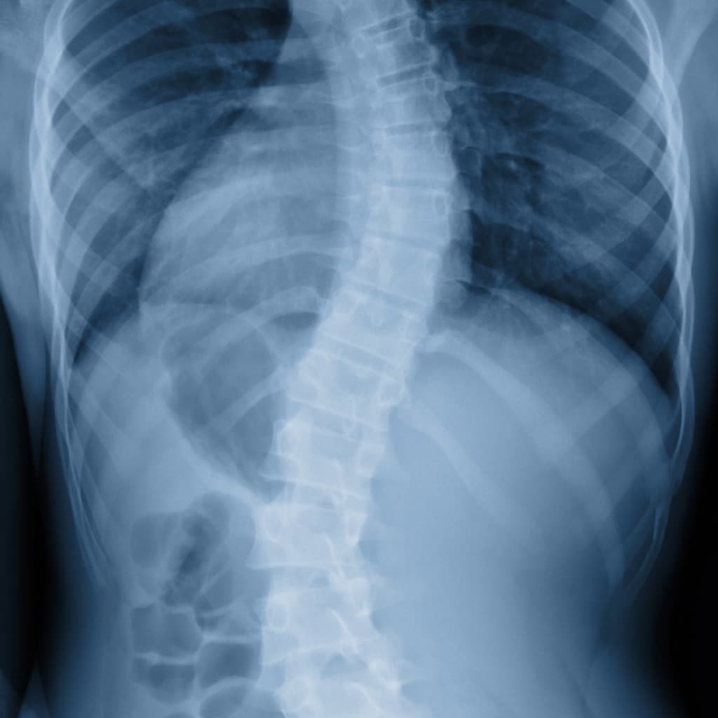 mild scoliosis x ray