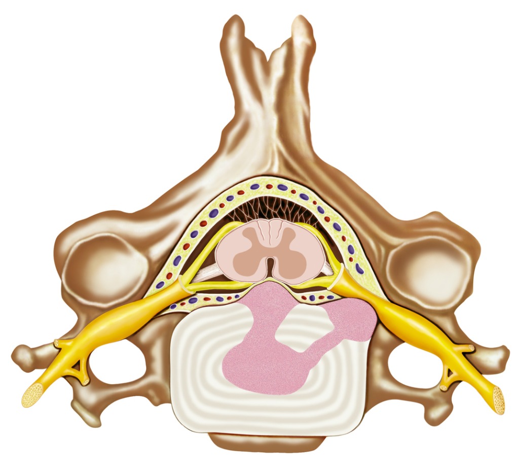 Herniated Disk in the Lower Back - OrthoInfo - AAOS