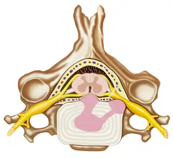 What You Need to Know About Herniated Discs – Centers for Artificial Disc