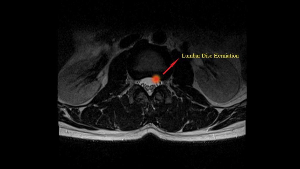 herniated disc x ray