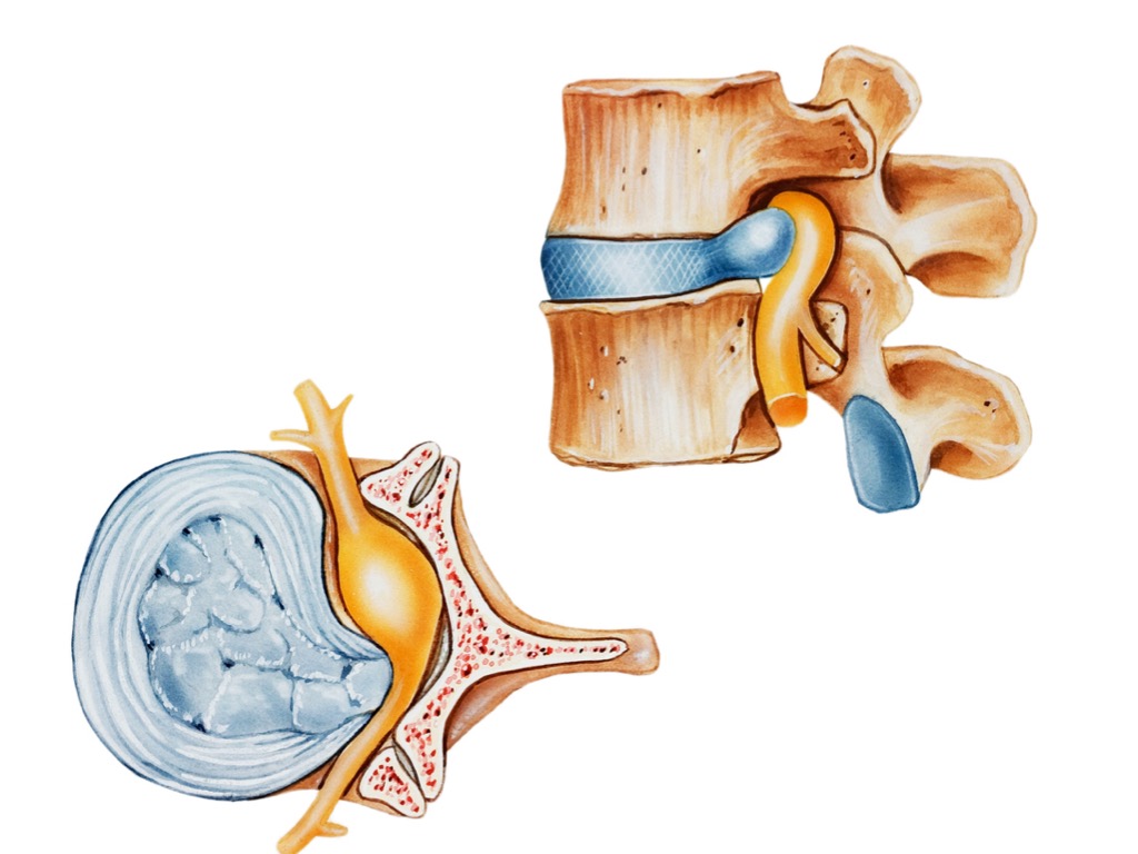Herniated Disc Lower Back Treatment Options