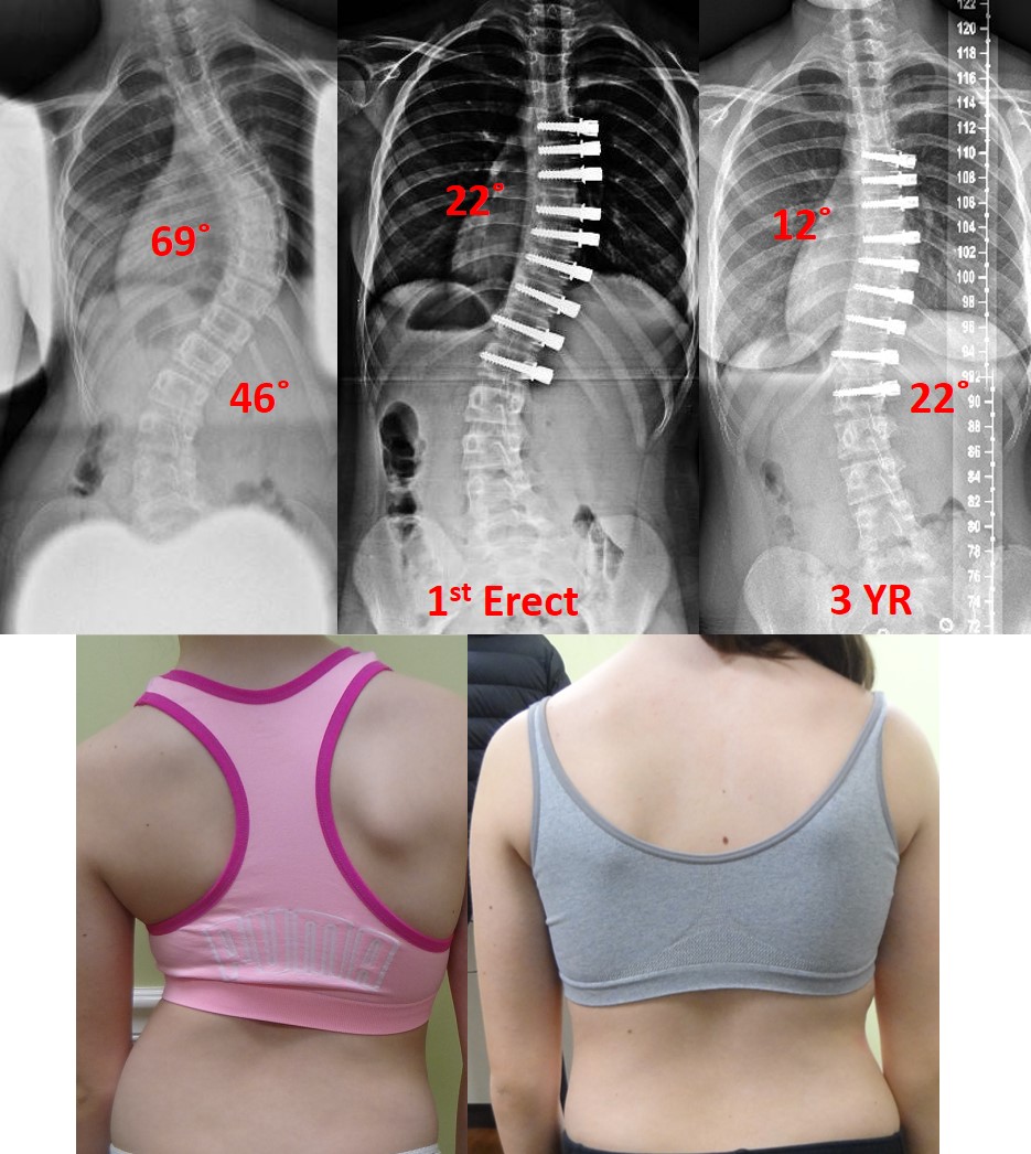 Scoliosis Tips for Taking Care of Your Body - BENT NOT BROKEN