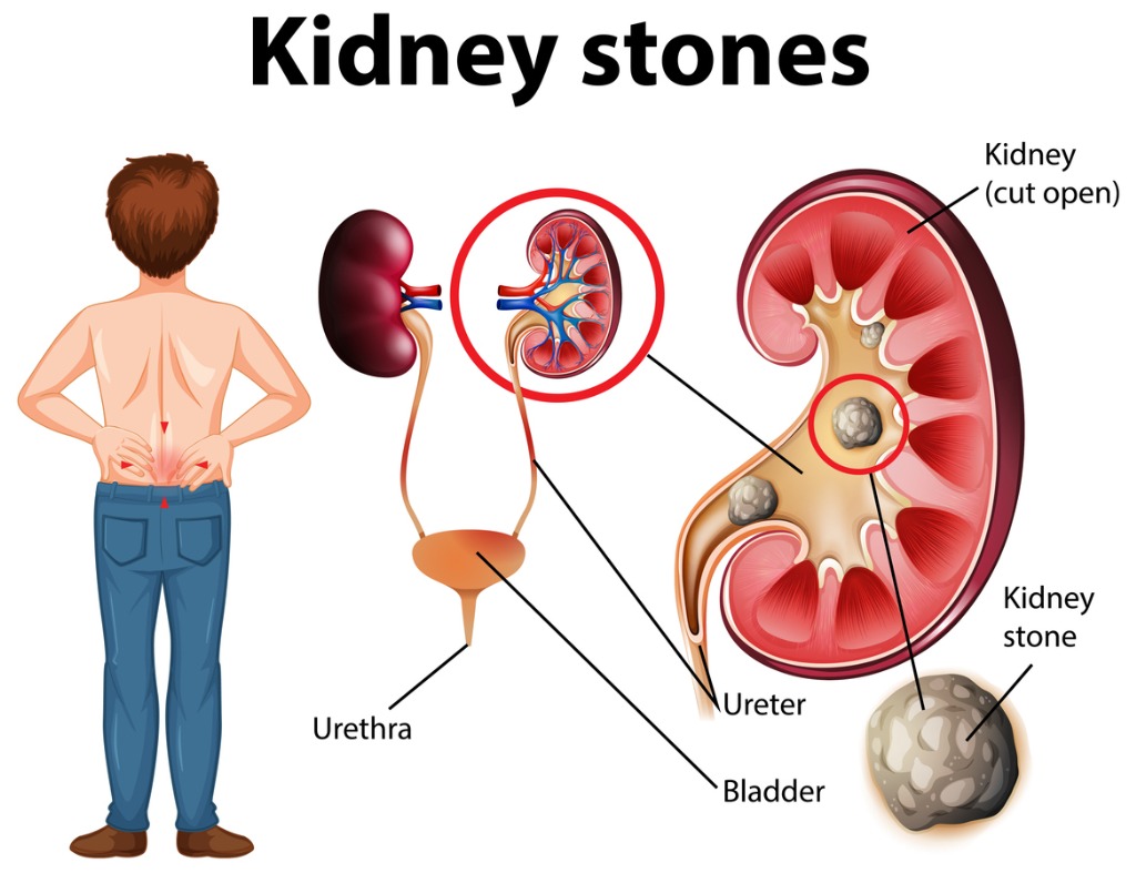 Back Pain Medical Condition Kidneys 