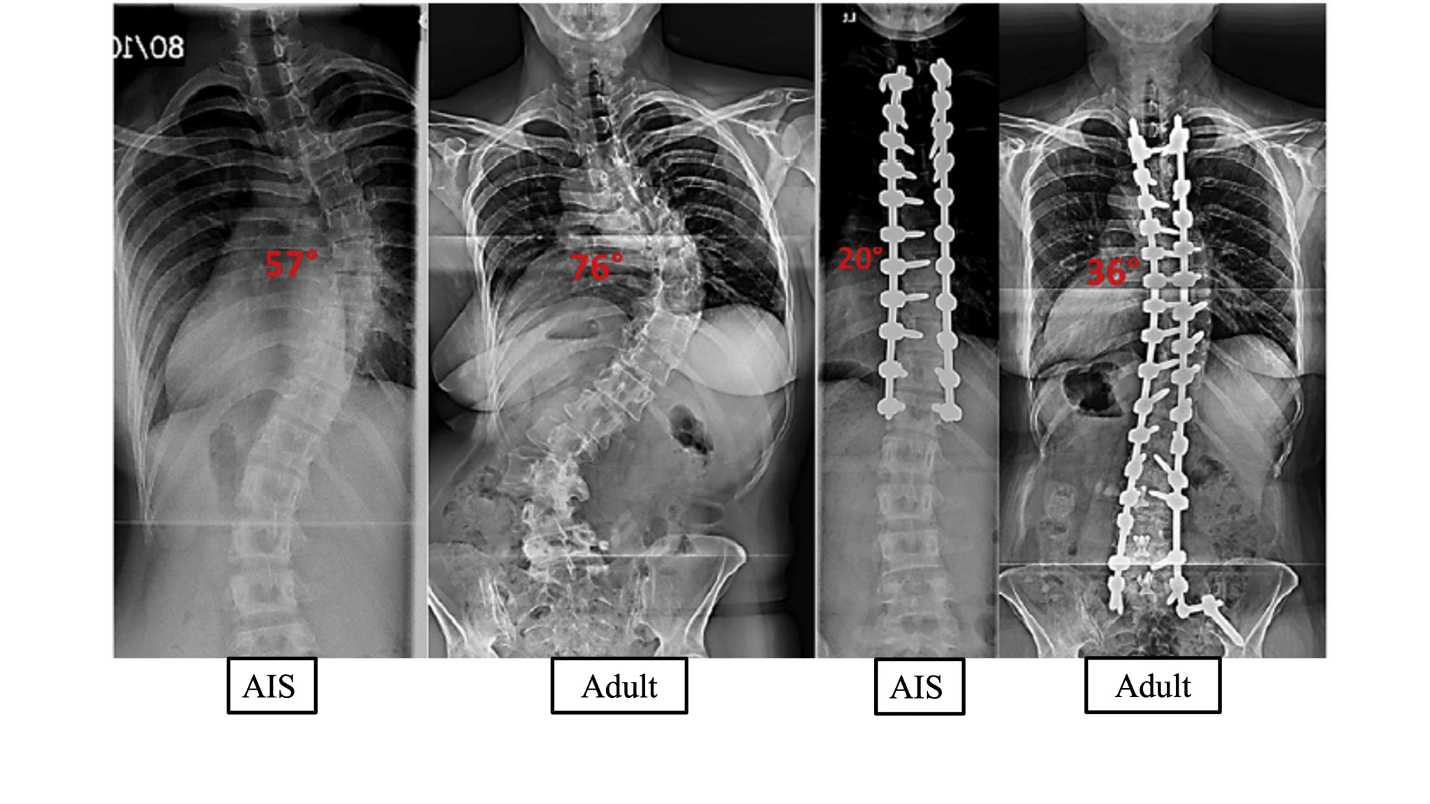 lumbar spine xray abnormal