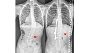 Levoscoliosis and Dextroscoliosis: How Are They Different?