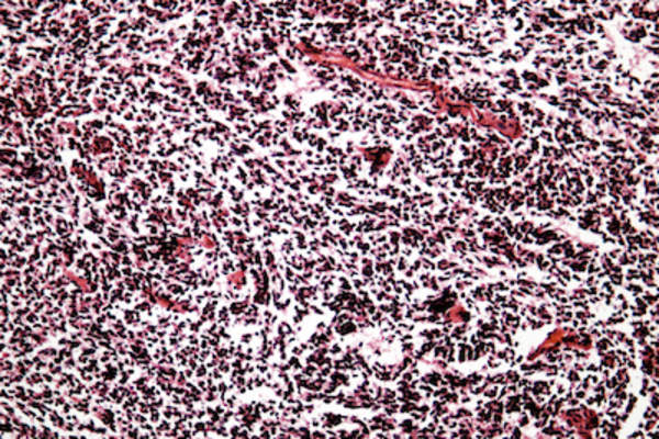 显微镜下小细胞癌。