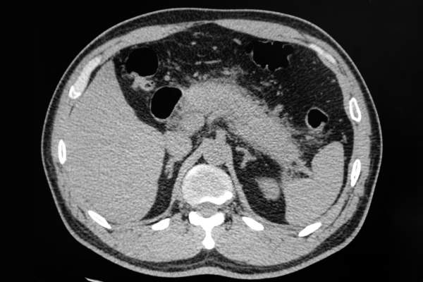 急性胰腺炎的CT图像