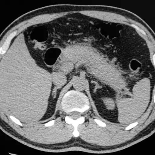急性胰腺炎CT图像