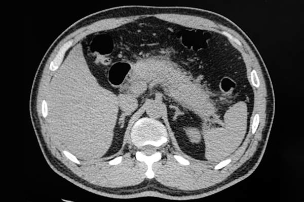 急性胰腺炎的CT图像