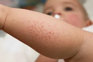 hives on arms