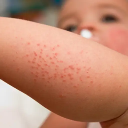 Skin Conditions That Mimic Chronic Hives Skin Conditions That Mimic Chronic Hives