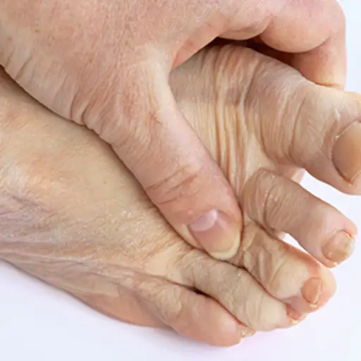 Woman with painful gout holding foot.