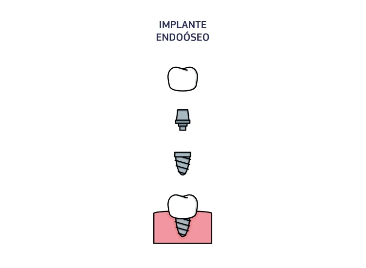 Infographic showing the components of an endosteal implant