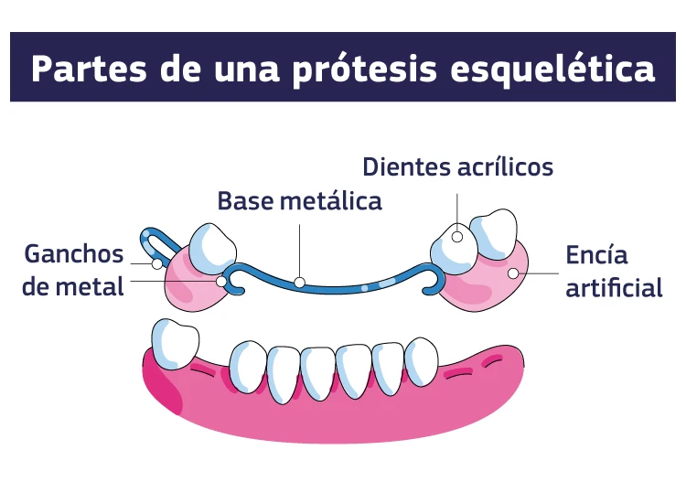 Una infografía que muestra las partes de una prótesis esquelética, con los ganchos de metal, la base metálica, los dientes acrílicos y la encía artificial que la componen.