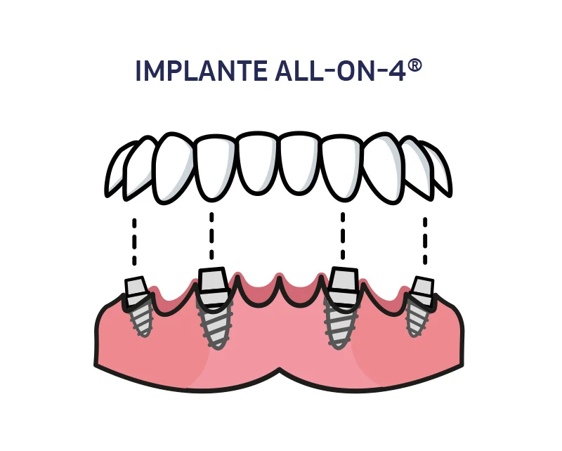 Infographic showing an all-on-4 implant and its components