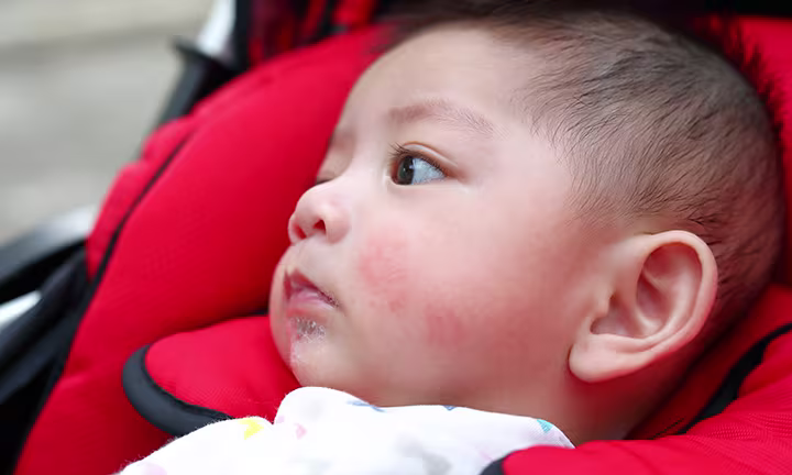 Teething and drool rash