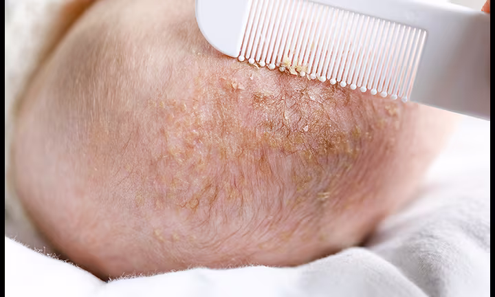Baby With Cradle Cap 