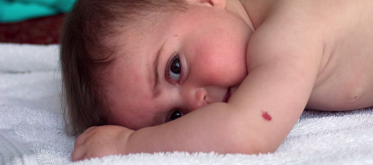 Blutschwämmchen bei Babys