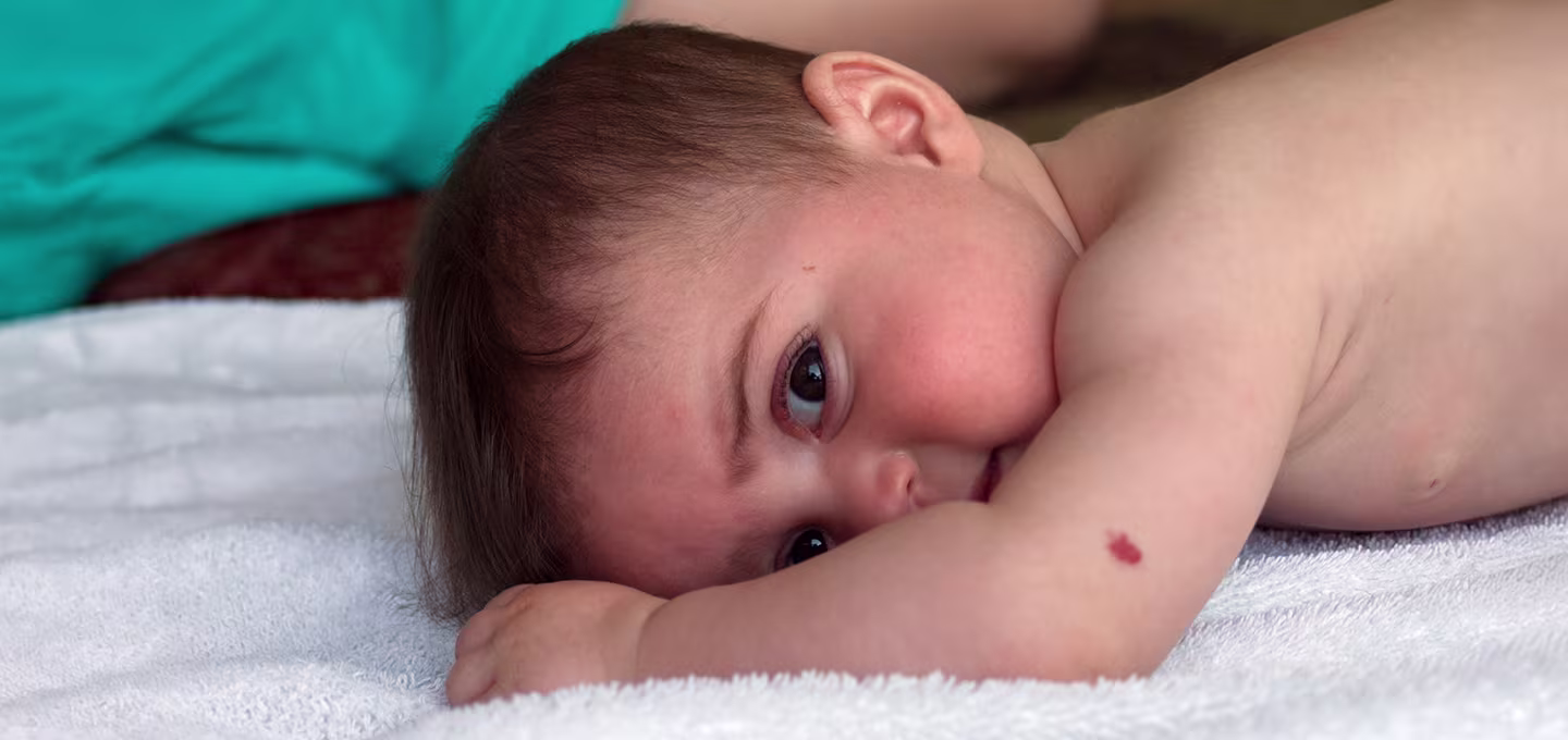 Bébé allongé sur le ventre sur une serviette blanche, regardant l’objectif, petite tache rouge sur le bras.