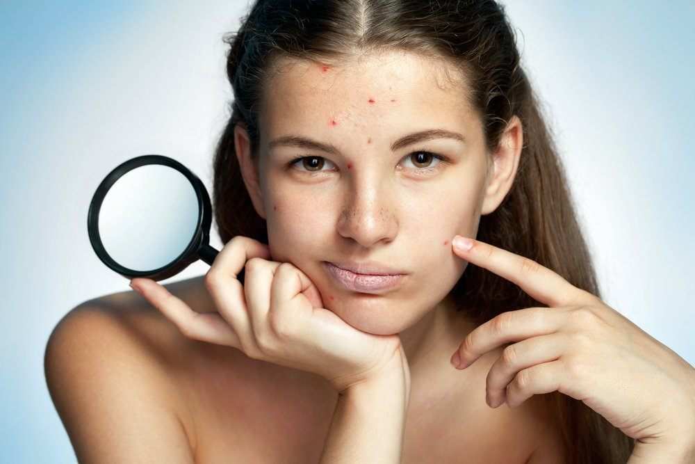 Teenage skin care tips for acne and blackheads