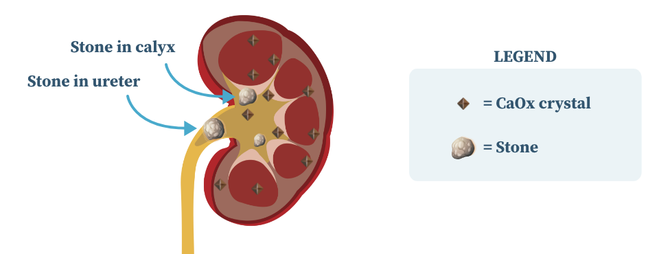Graphic showing that calcium oxalate crystals combine to form kidney stones in people with primary hyperoxaluria. Kidney - Right