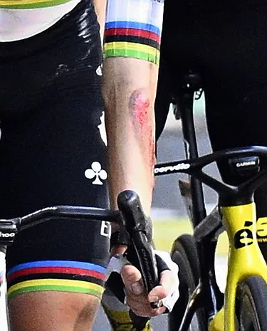 The injured arm of Slovenian Tadej Pogacar of UAE Team Emirates pictured at the finish of stage 11 of the 2025 Tour de France cycling, from and to Toulouse (154km), on Wednesday 16 July 2025 in France. The 112th edition of the Tour de France starts on Saturday 5 July in Lille, France, and will finish in Paris, France on the 27th of July. BELGA PHOTO JASPER JACOBS