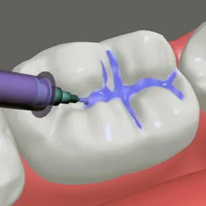sealant-application