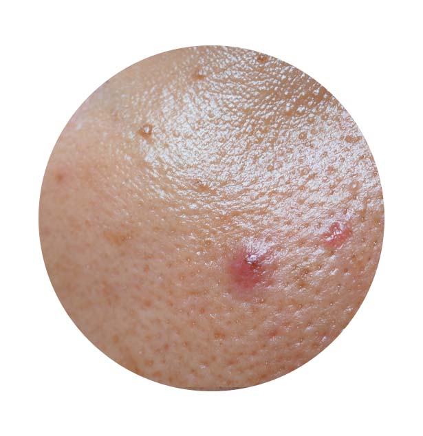 Pele com Acne e Marcas de Espinha