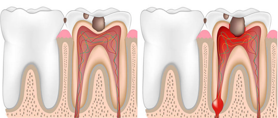 淺層蛀牙(左) vs 深層蛀牙(右)