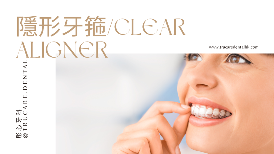 隱形牙箍/Clear ALigner