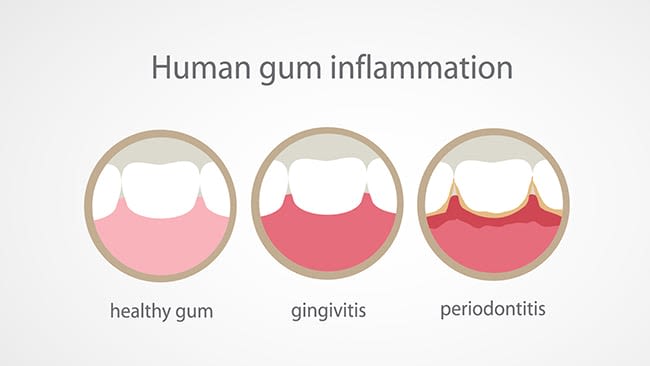 Inflamed Gums: Causes & Treatments - Image 1 - Listerine - ar-001